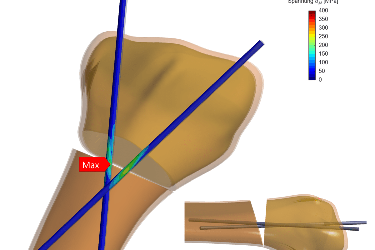 StentBlend_MediTechv2
